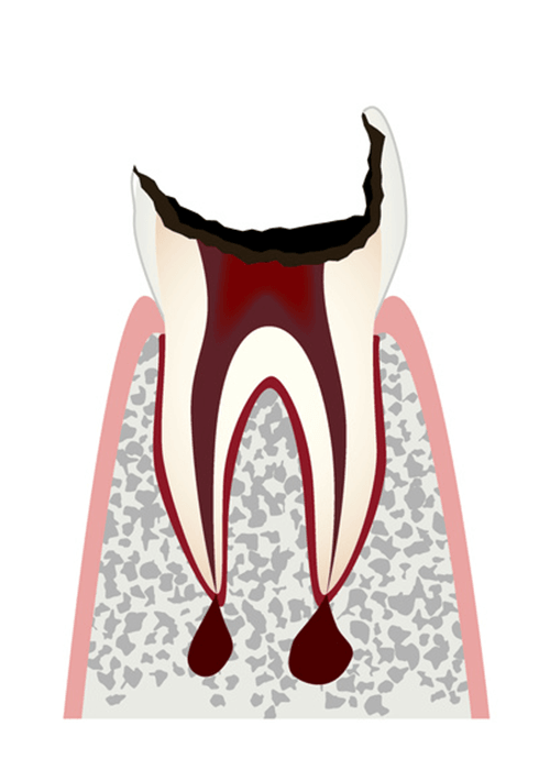 歯の根の治療 or 抜歯